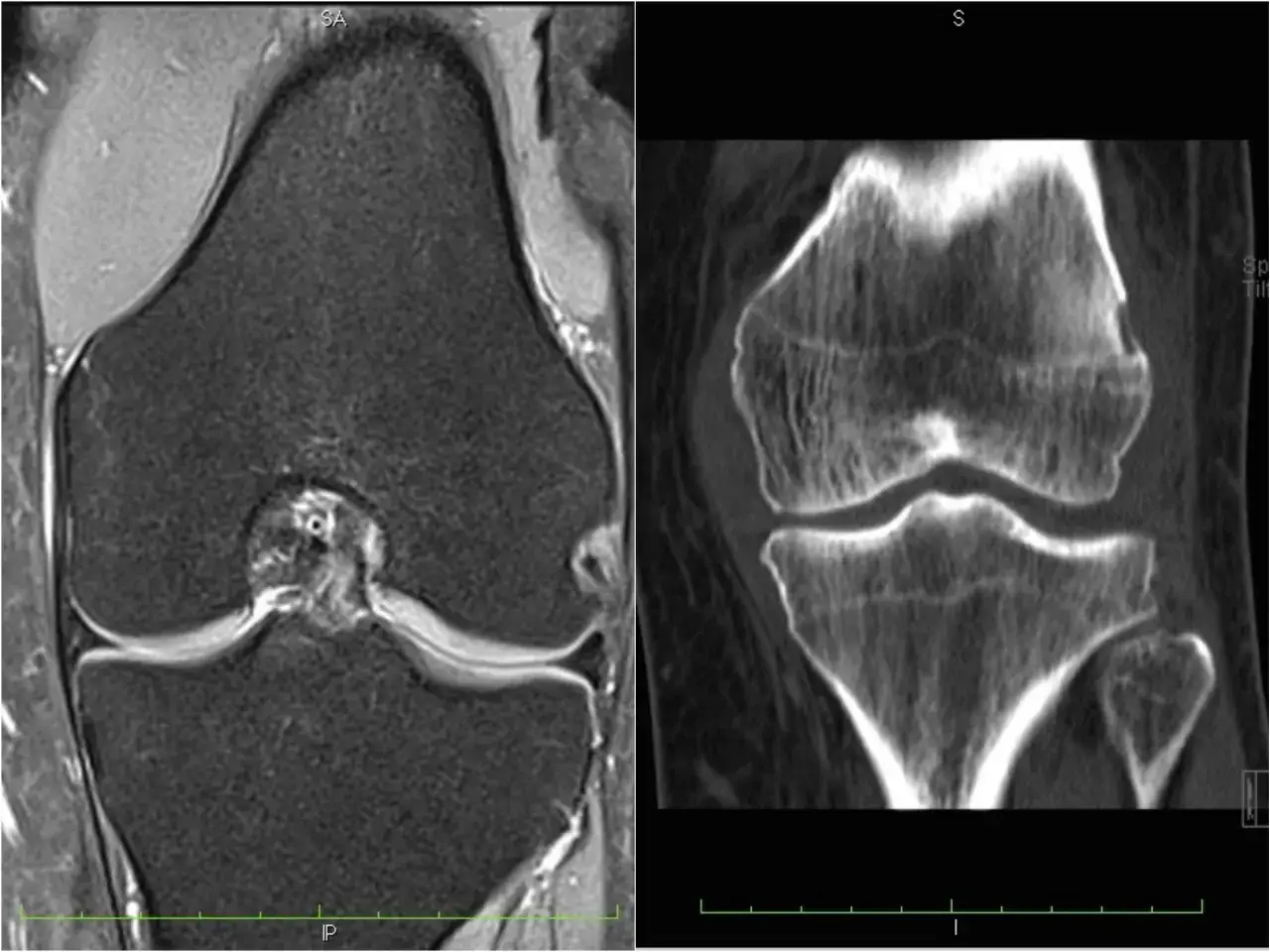 porównanie USG RTG MRI kolana