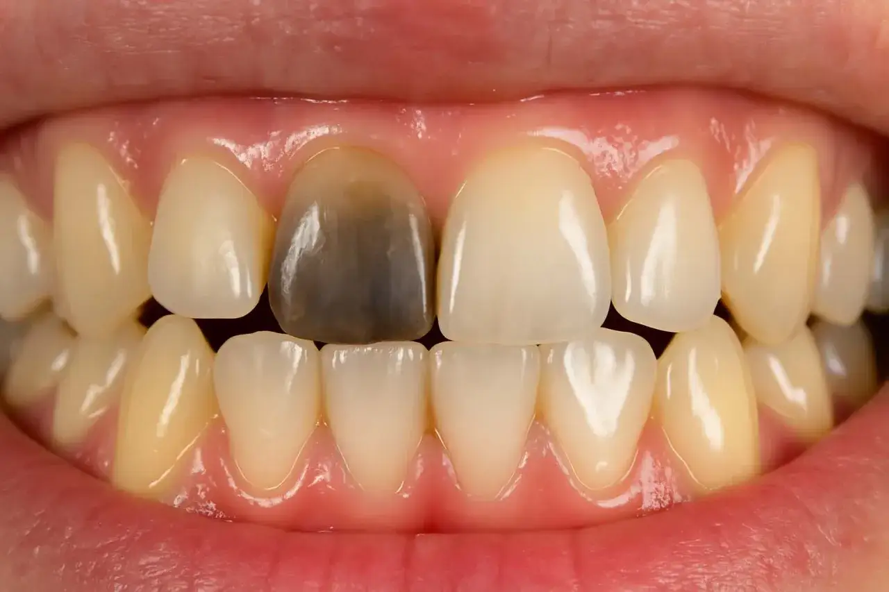 Widoczne zęby, jeden z nich jest ciemny, z widocznym czarnym dziąsłem przy zębie.