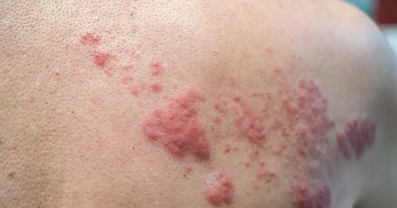 p&oacute;łpasiec objawy początkowe dorosły