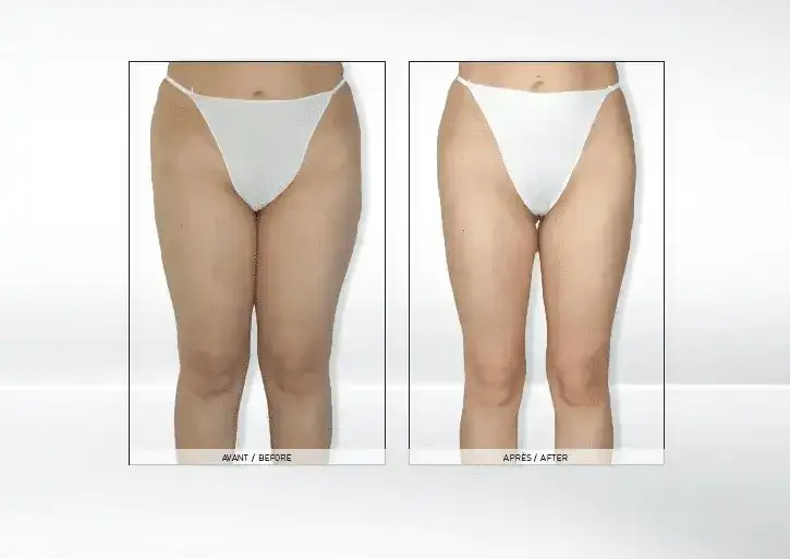 zabieg endermologii alliance na ciele