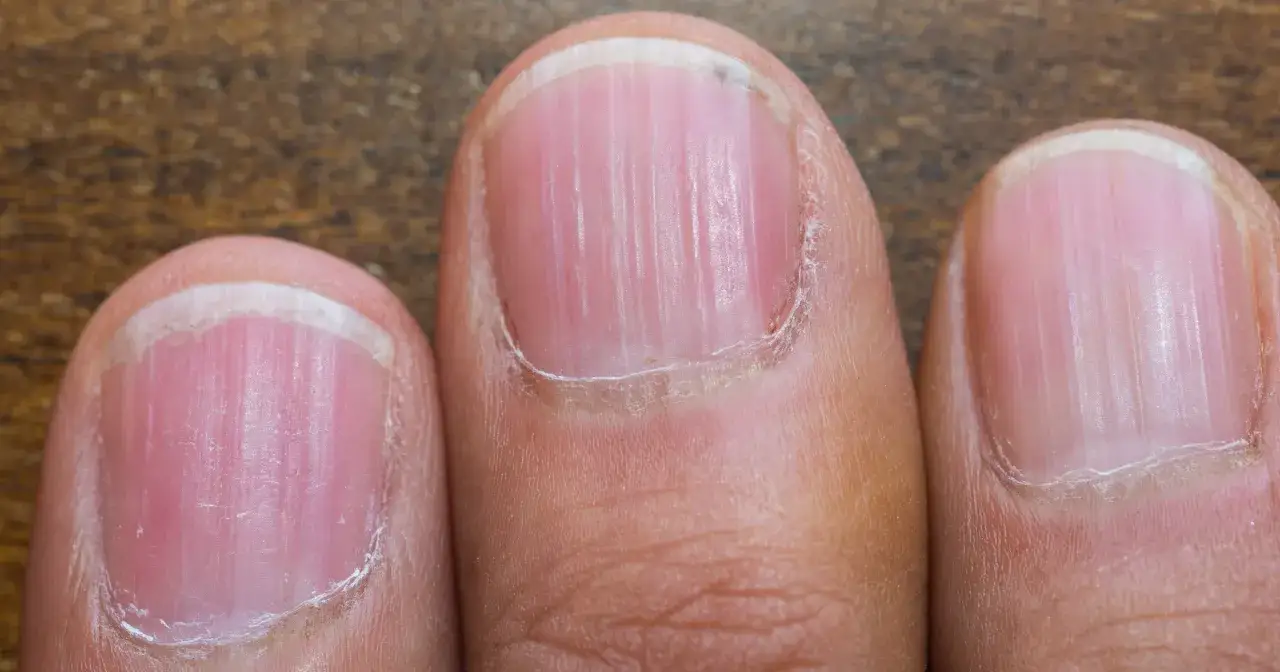 Paznokcie z pionowymi prążkami i bladym p&oacute;łksiężycem mogą być nietypowe objawy niedoboru żelaza.