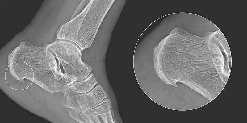 Zdjęcie Ból pięty: poznaj przyczyny i skutki, które mogą cię zaskoczyć