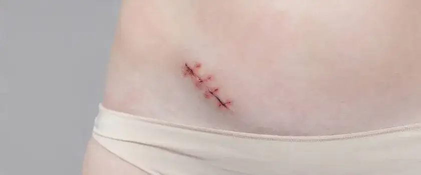 Zdjęcie Objawy wyrostka u 15 latka: Jak nie przegapić niebezpiecznych sygnałów