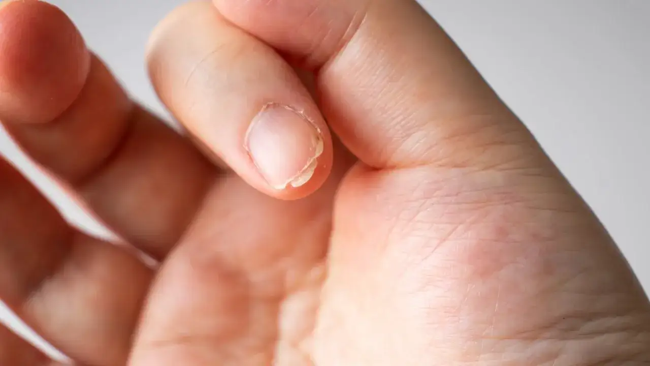 Zdjęcie Co zrobić jeśli paznokcie rosną w dół? Skuteczne metody pielęgnacji