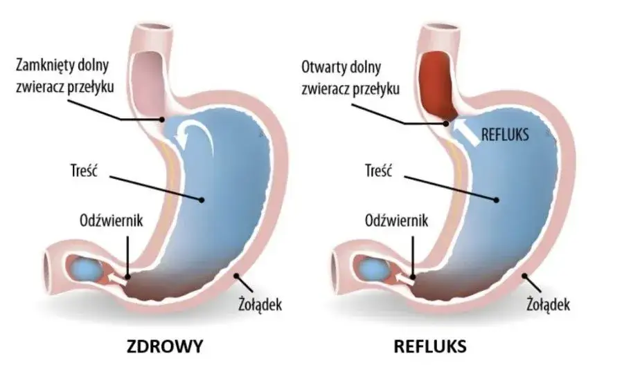 Zdjęcie Refluks przyczyny: Jak unikać dolegliwości i poprawić zdrowie?