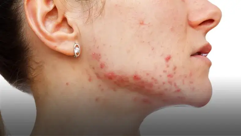 Zdjęcie Skuteczne sposoby na pryszcze na twarzy – uniknij trądziku już dziś