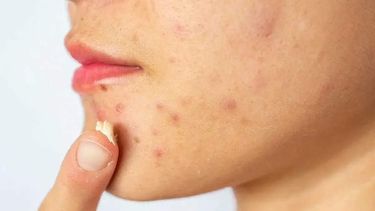 Zdjęcie Skuteczne metody na pryszcze podskórne, które naprawdę działają