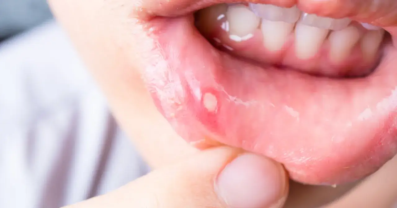 Bolesne afty w jamie ustnej, kt&oacute;re mogą pojawić się w ciąży, są widoczne na zdjęciu.