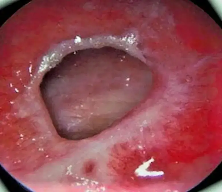 Perforacja przegrody nosowej objawy