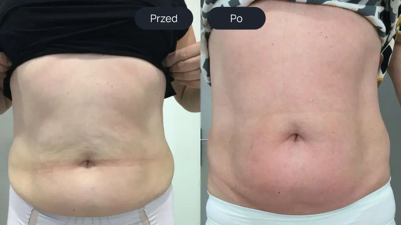 Porównanie brzucha przed i po endermologii. Widoczne wygładzenie skóry i redukcja tkanki tłuszczowej, co pokazuje pozytywne endermologia brzuch efekty.