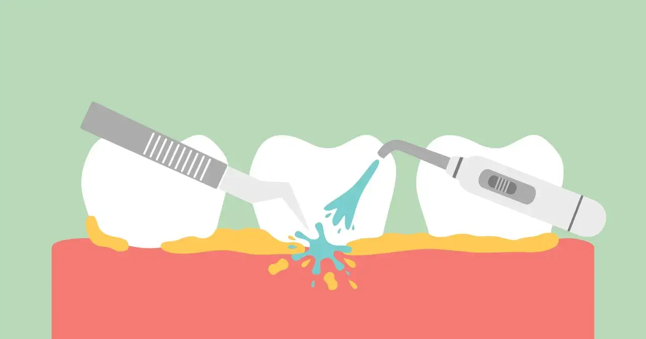 Usuwanie kamienia nazębnego za pomocą skalera i irygatora.