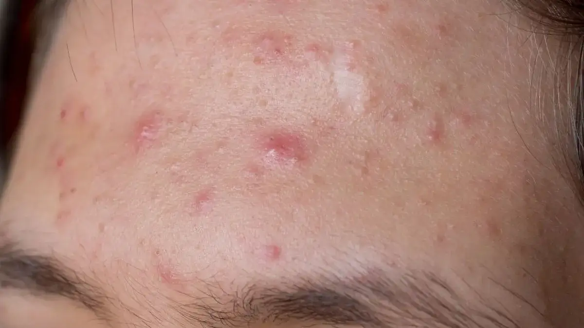 apteczka z preparatami na trądzik i naturalne składniki