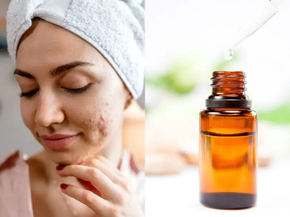 dziewczyna z pryszczem przed lustrem