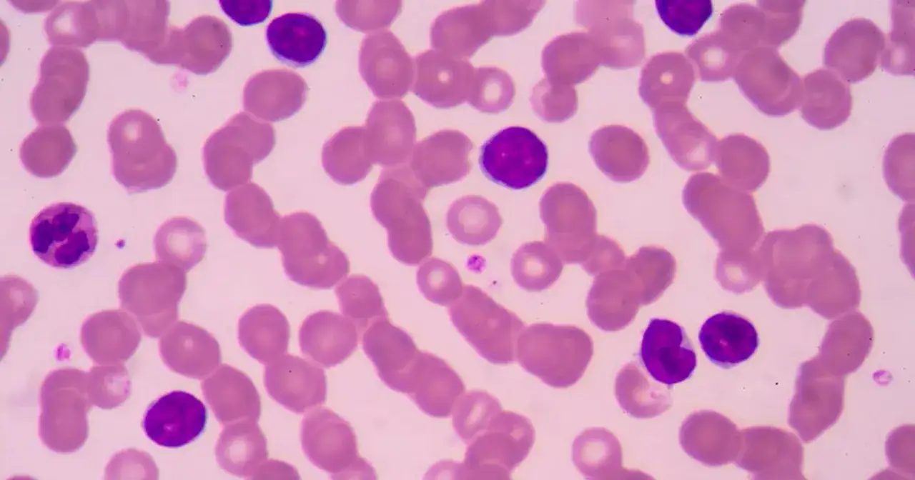 Widok mikroskopowy krwi: liczne czerwone krwinki i kilka fioletowych limfocyt&oacute;w. Wysokie limfocyty mogą wskazywać na infekcję.