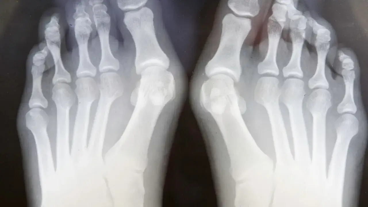 rentgen stopy haluksy diagnostyka