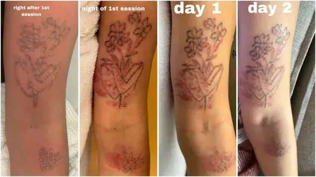 Świeży tatuaż proces gojenia