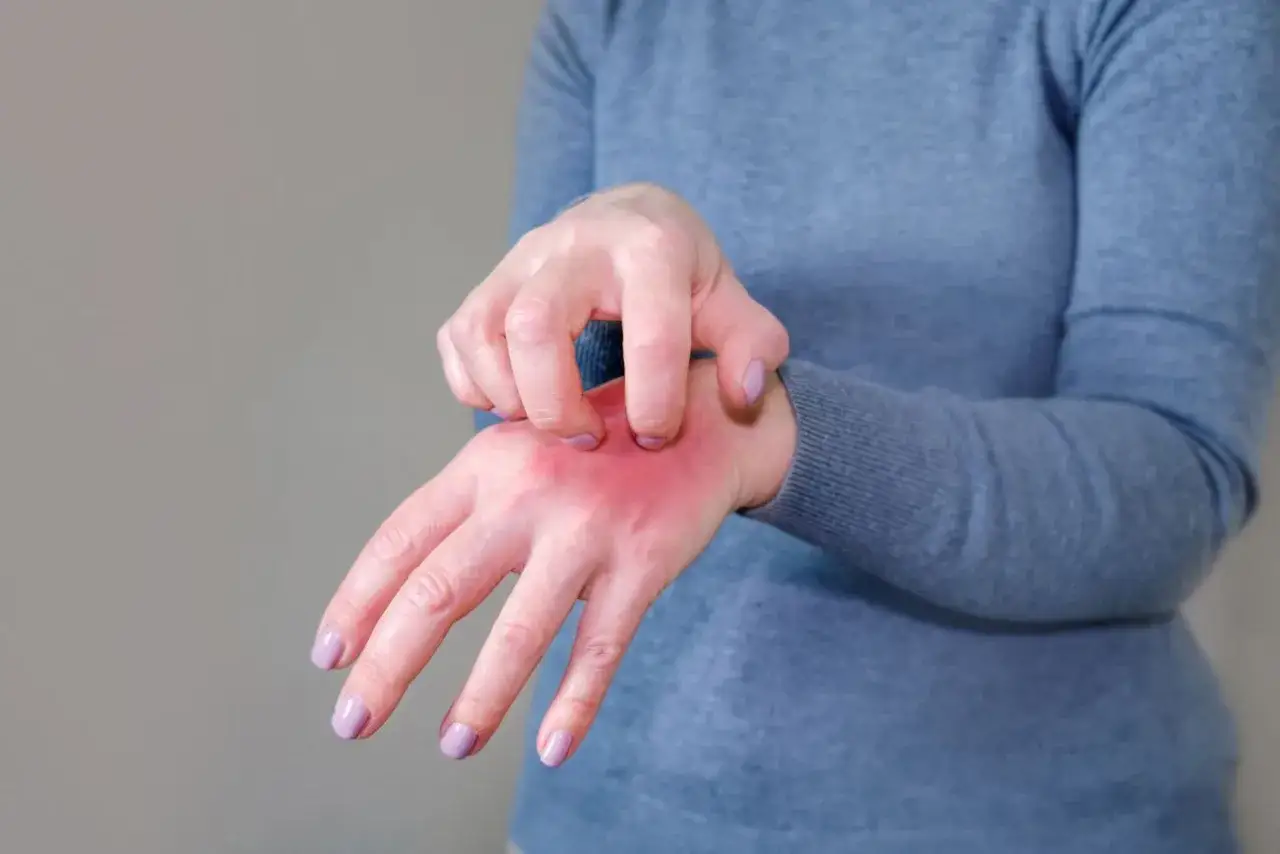 Dłoń zaczerwieniona i swędząca, objawy uczulenia na hybrydę.