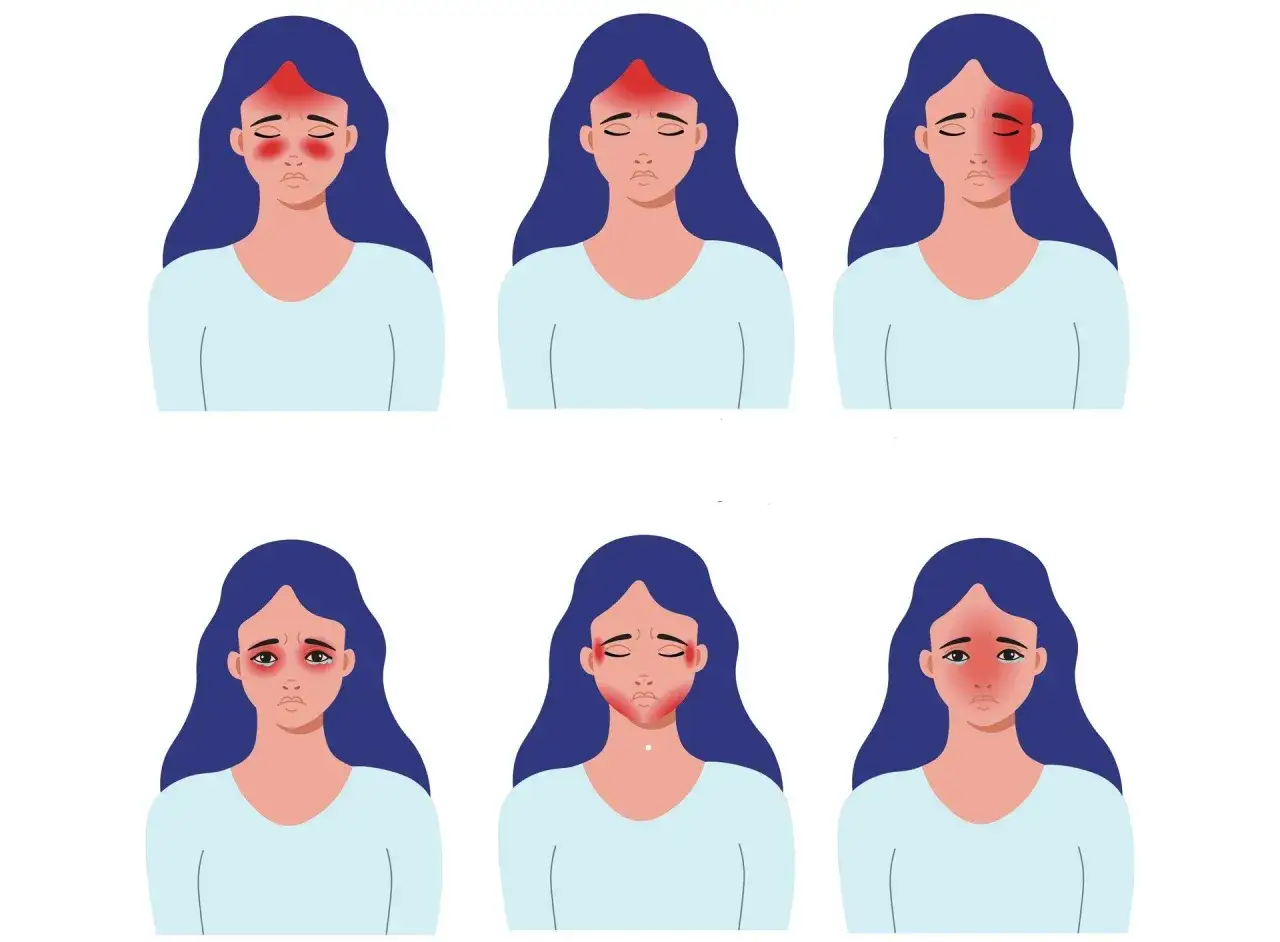 Przyczyny bólu głowy w skroniach infografika