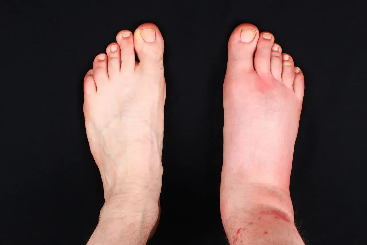 Opuchnięte kostki mechanizm powstawania obrzęku