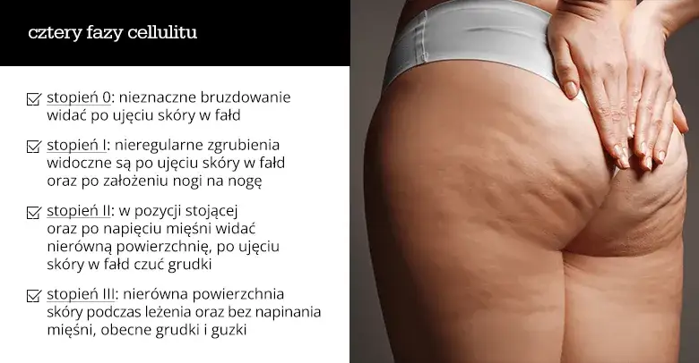 kobieta z cellulitem nogi, przyczyny cellulitu infografika