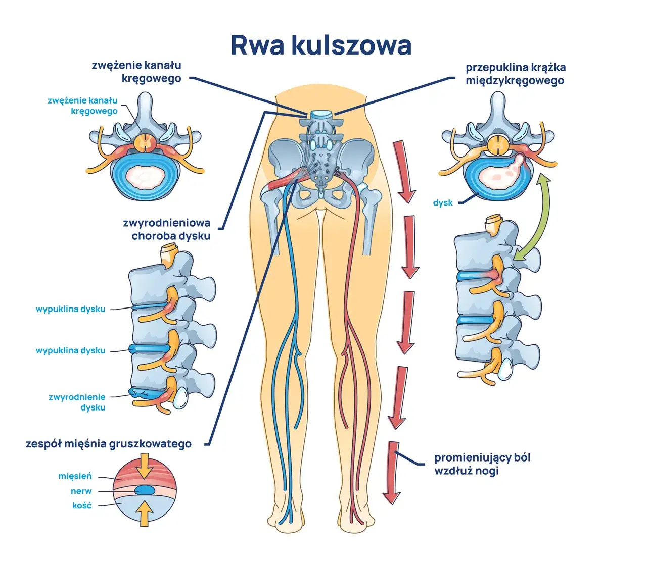 rwa kulszowa schemat promieniowania b&oacute;lu