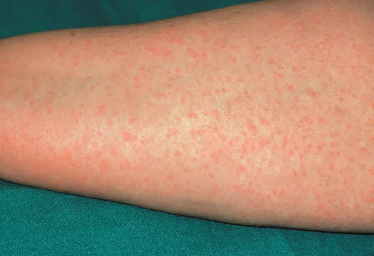 Rozsiana, czerwona wysypka na sk&oacute;rze ramienia, mogąca być objawem uczulenia na penicylinę.