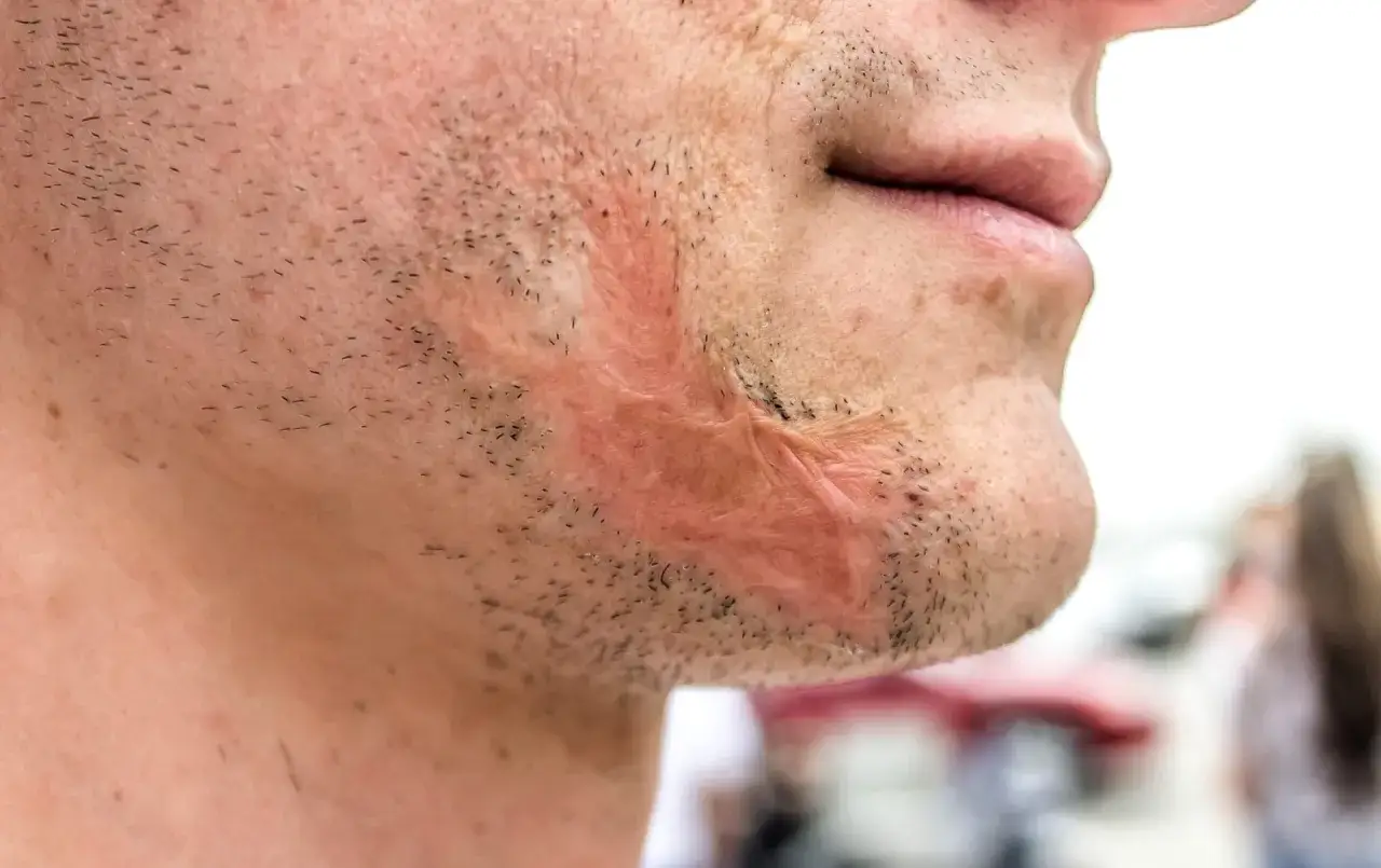 Oparzenie olejem na twarzy, widoczna blizna i zaczerwienienie. Szukając informacji, co na oparzenie olejem, natrafiasz na takie obrazy.