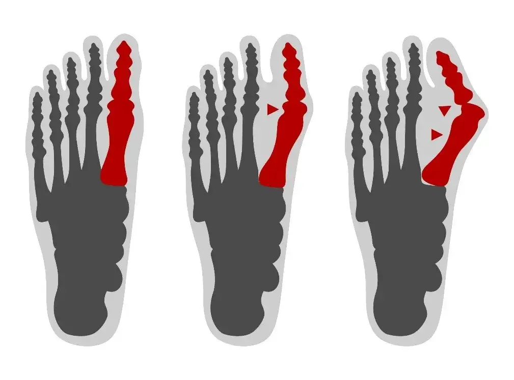 Zdjęcie Operacja haluksów gdzie najlepiej: wybierz najlepsze kliniki w Polsce