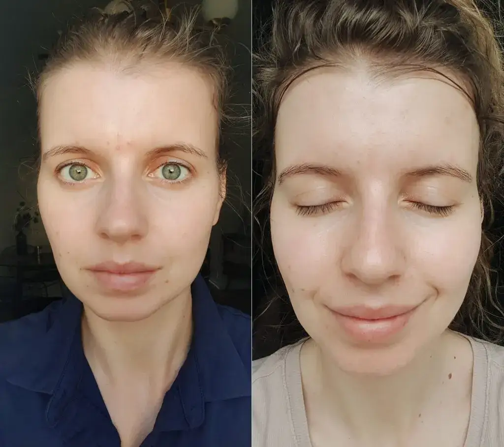 Zdjęcie Tłusta cera: 8 skutecznych sposobów na piękną i zdrową skórę