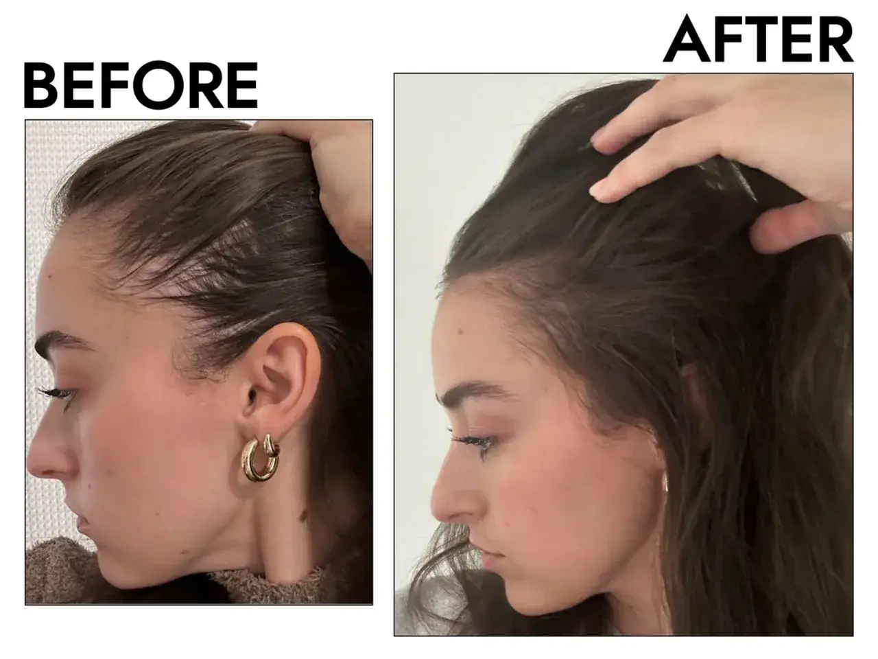 Przed i po: widoczna poprawa linii włos&oacute;w, co sugeruje skuteczne metody na to, jak zapobiec wypadaniu włos&oacute;w.