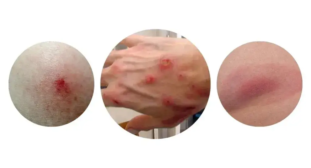 obrzeżek gołębi, ukąszenie obrzeżka