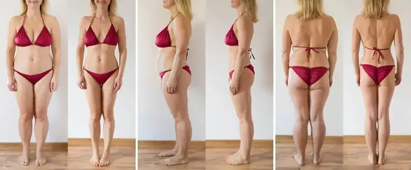 liposukcja kawitacyjna przed i po efekty
