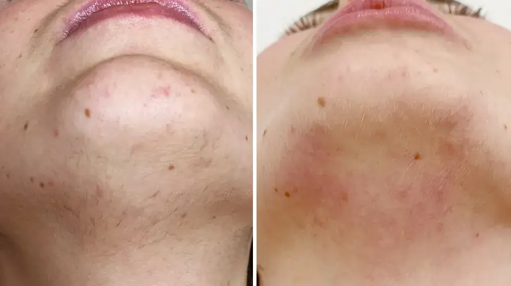 skóra po depilacji laserowej przed i po