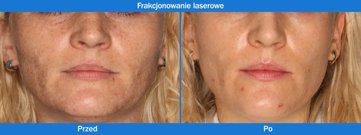 Zdjęcie Ile zabiegów laserem frakcyjnym CO2 potrzebujesz dla najlepszych efektów?