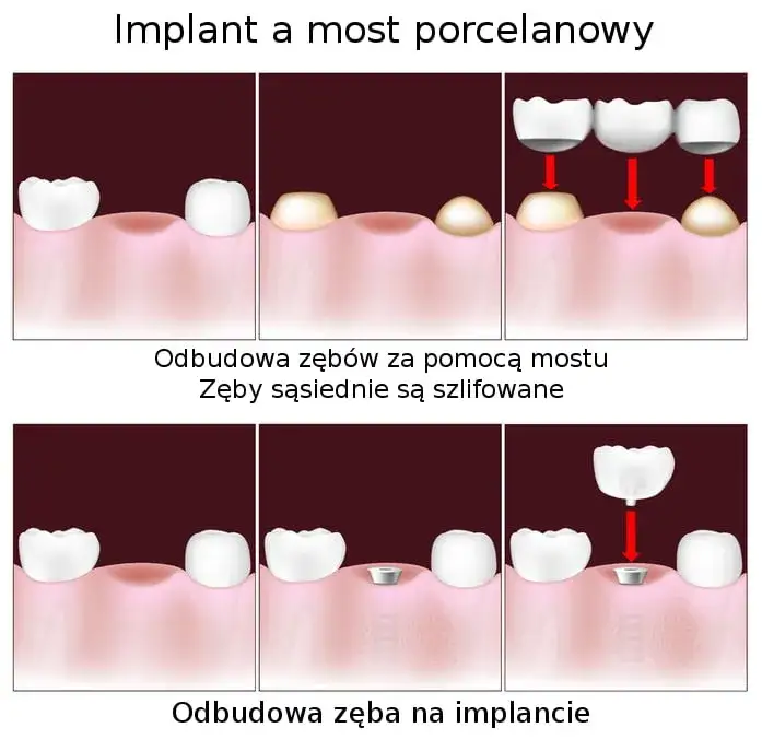 Most protetyczny a implant zęba porównanie wyglądu