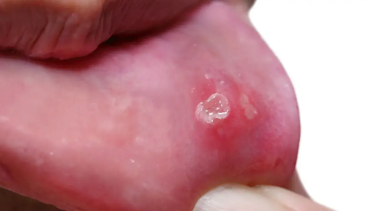 Widoczne owrzodzenie na wardze, przypominające opryszczkę u dzieci. Czerwona obwódka i białawe pęcherzyki.