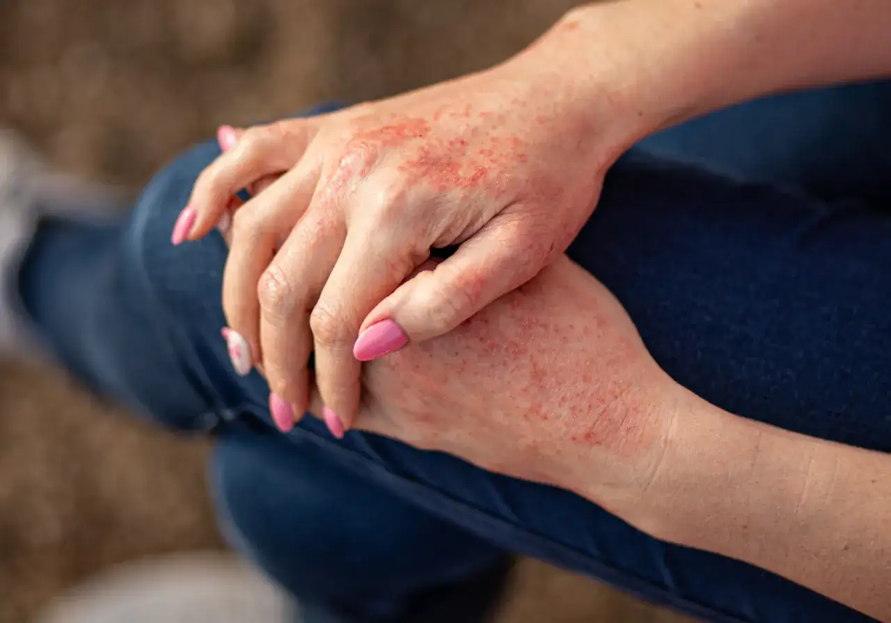 Dłonie z zaczerwienionymi, swędzącymi zmianami skórnymi, które mogą być objawem egzemy.
