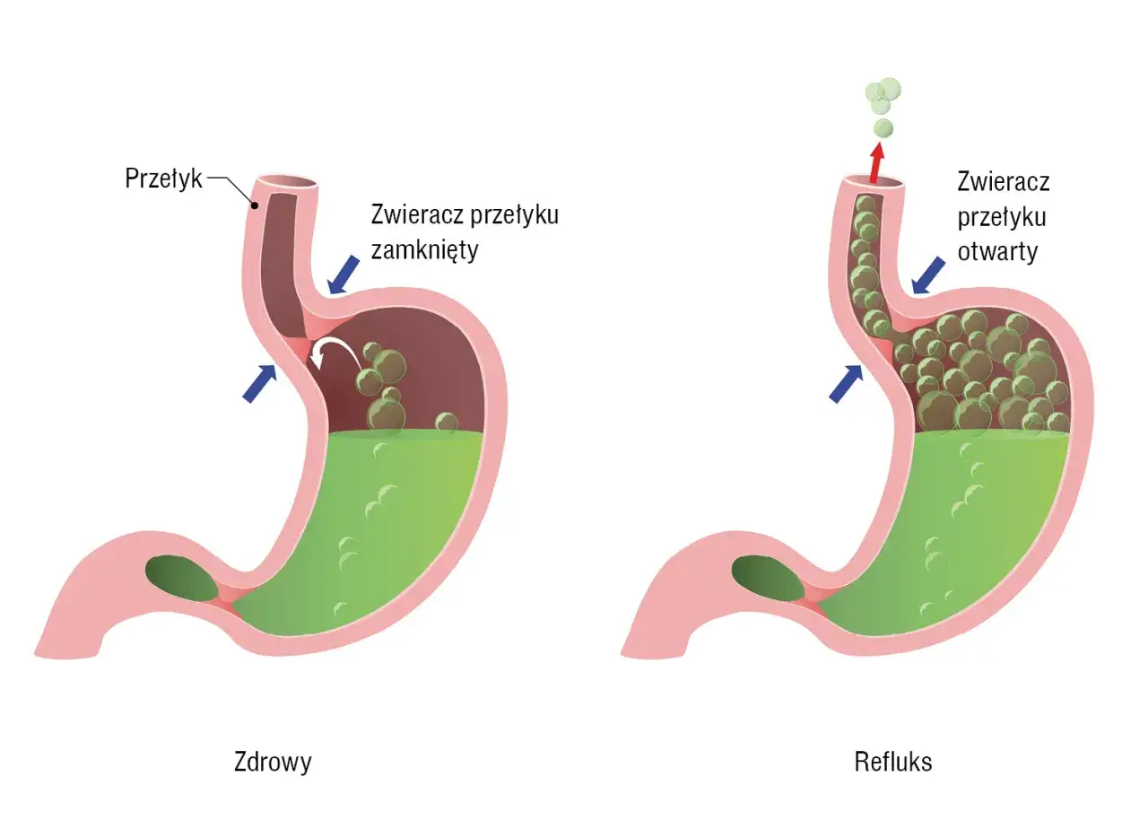 Objawy refluksu przełyku infografika