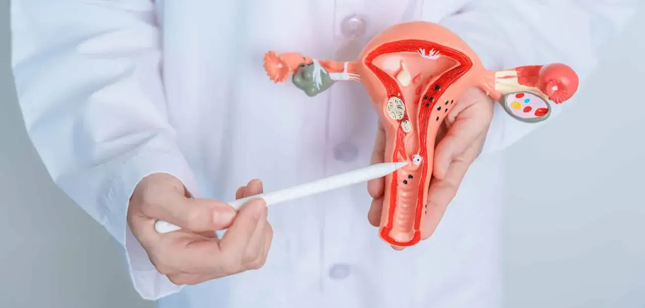 Model narządu rodnego kobiety, wskazujący na zmiany mogące być objawami raka szyjki macicy.