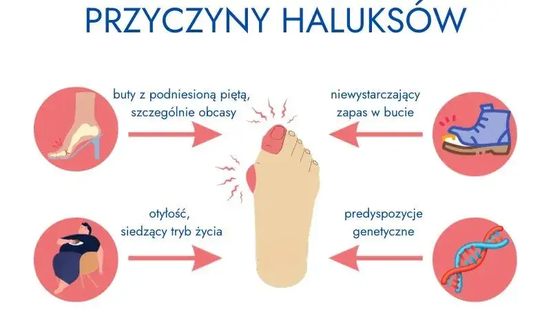 haluksy przyczyny obuwie genetyka