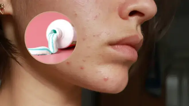 Zdjęcie Pryszcz w 1 dzień? Skuteczne triki i czego unikać!