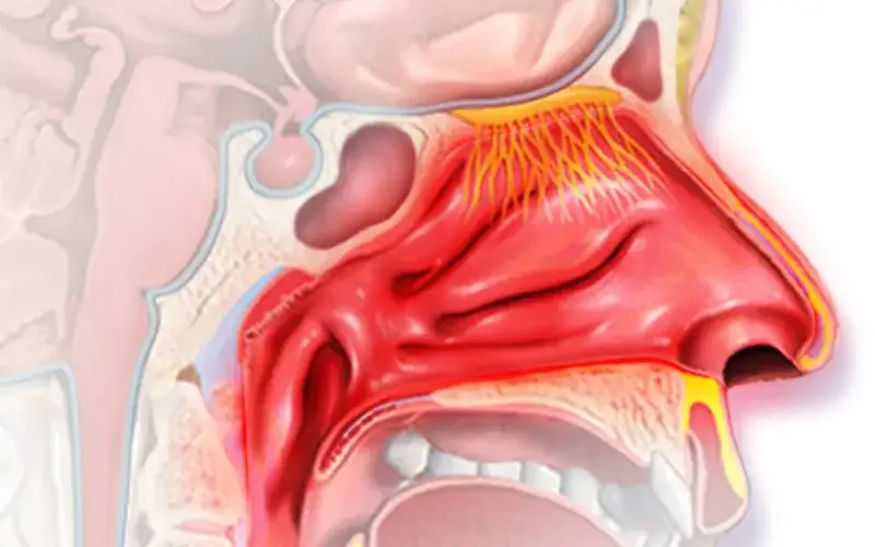 anatomia nosa dziecka, wysuszona śluzówka nosa
