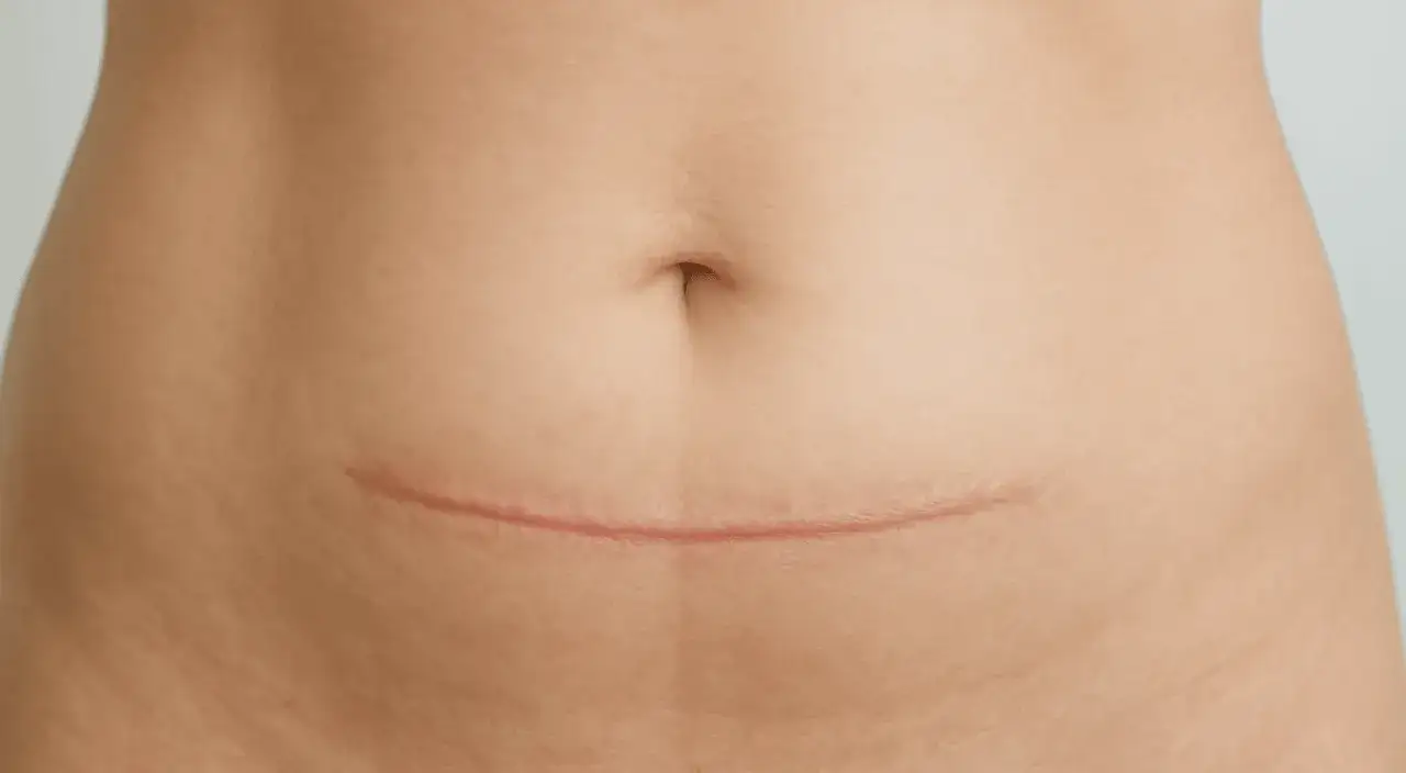 Blizna po cesarskim cięciu, ważny element powrotu do formy. Fizjoterapia po CC pomaga w regeneracji.