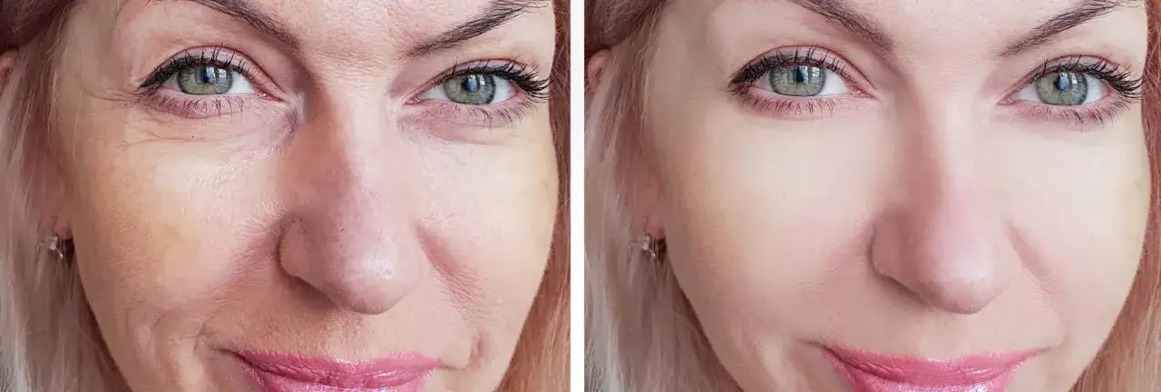 porównanie kosztów botoks mezobotoks rocznie