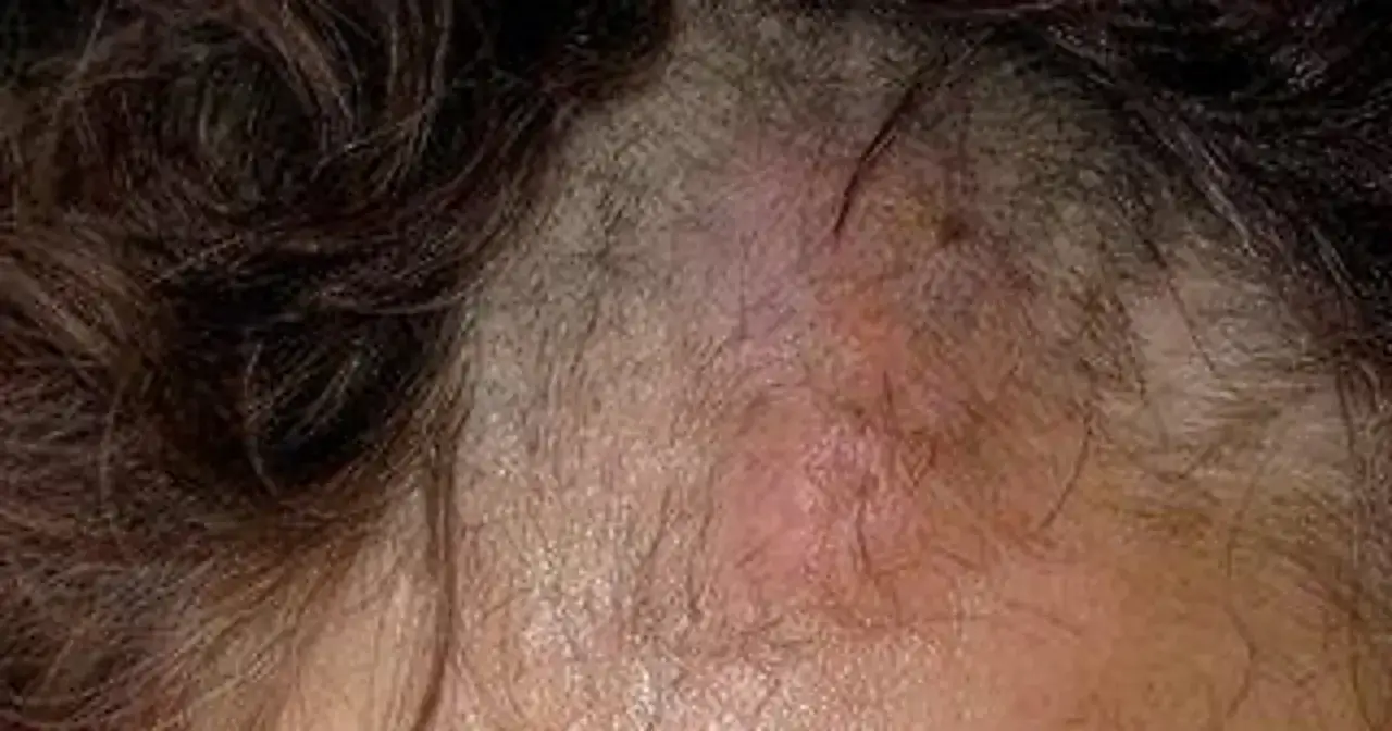 Zmiana skórna na głowie, która może pomóc odróżnić czyraka od pryszcza. Widoczna zaczerwieniona, opuchnięta zmiana.