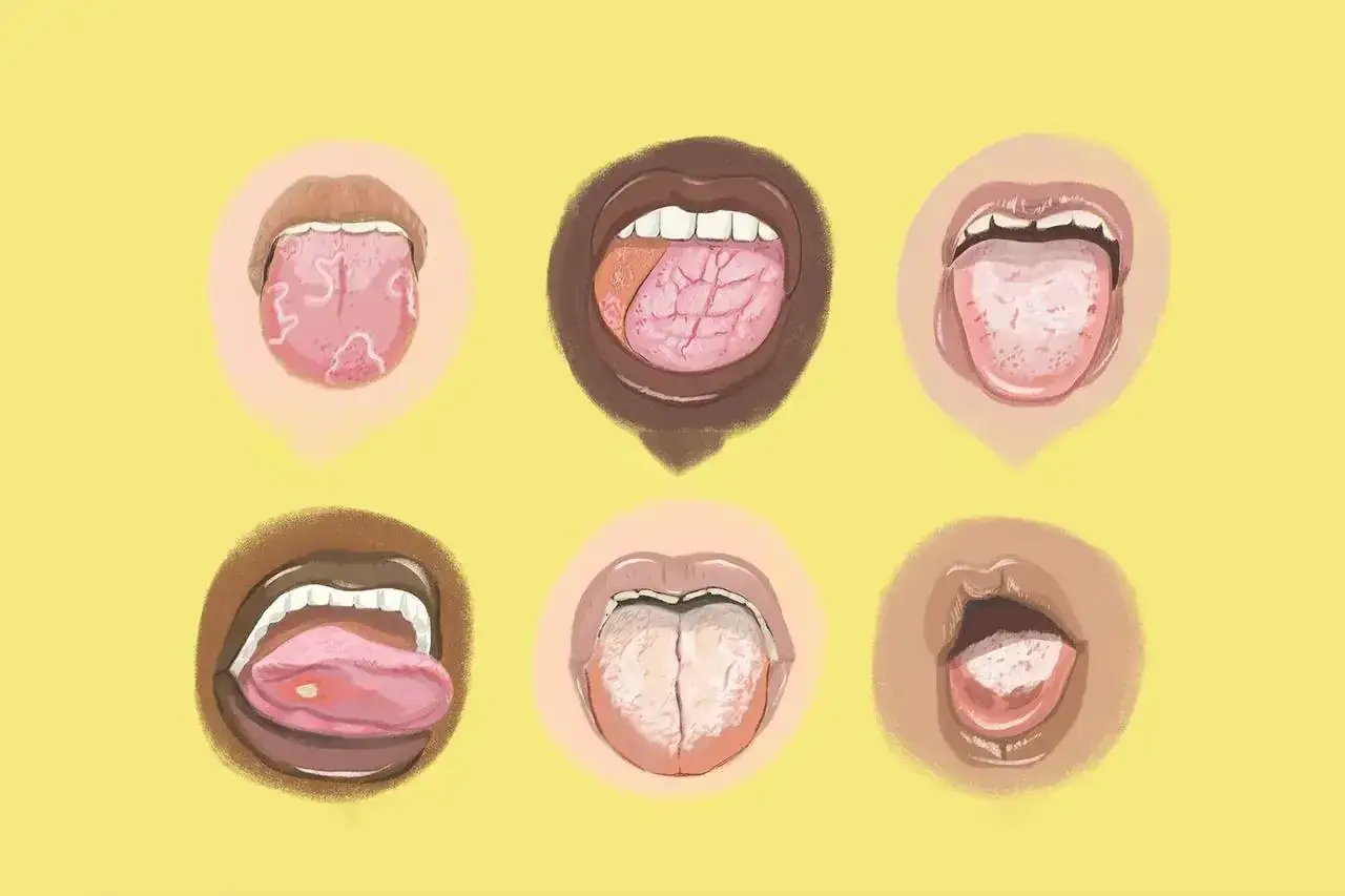 R&oacute;żne stany języka, w tym opryszczkowe zapalenie jamy ustnej, z widocznymi zmianami i nalotami.