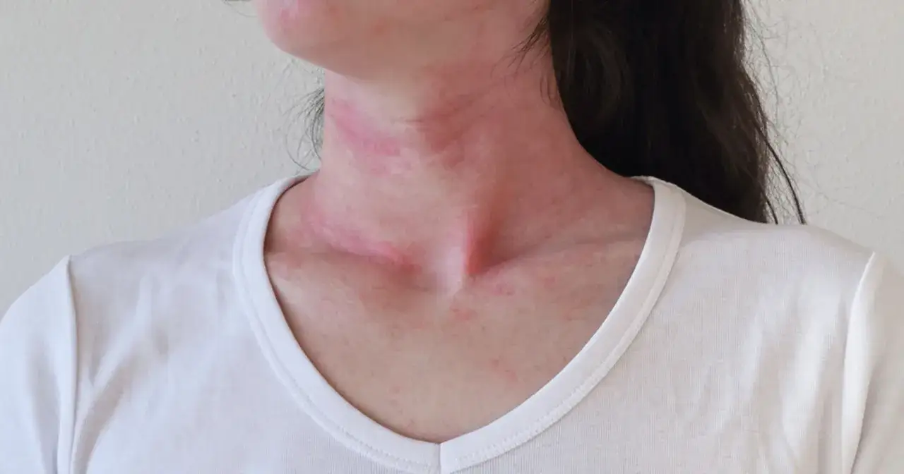 Wstrząs anafilaktyczny objawy