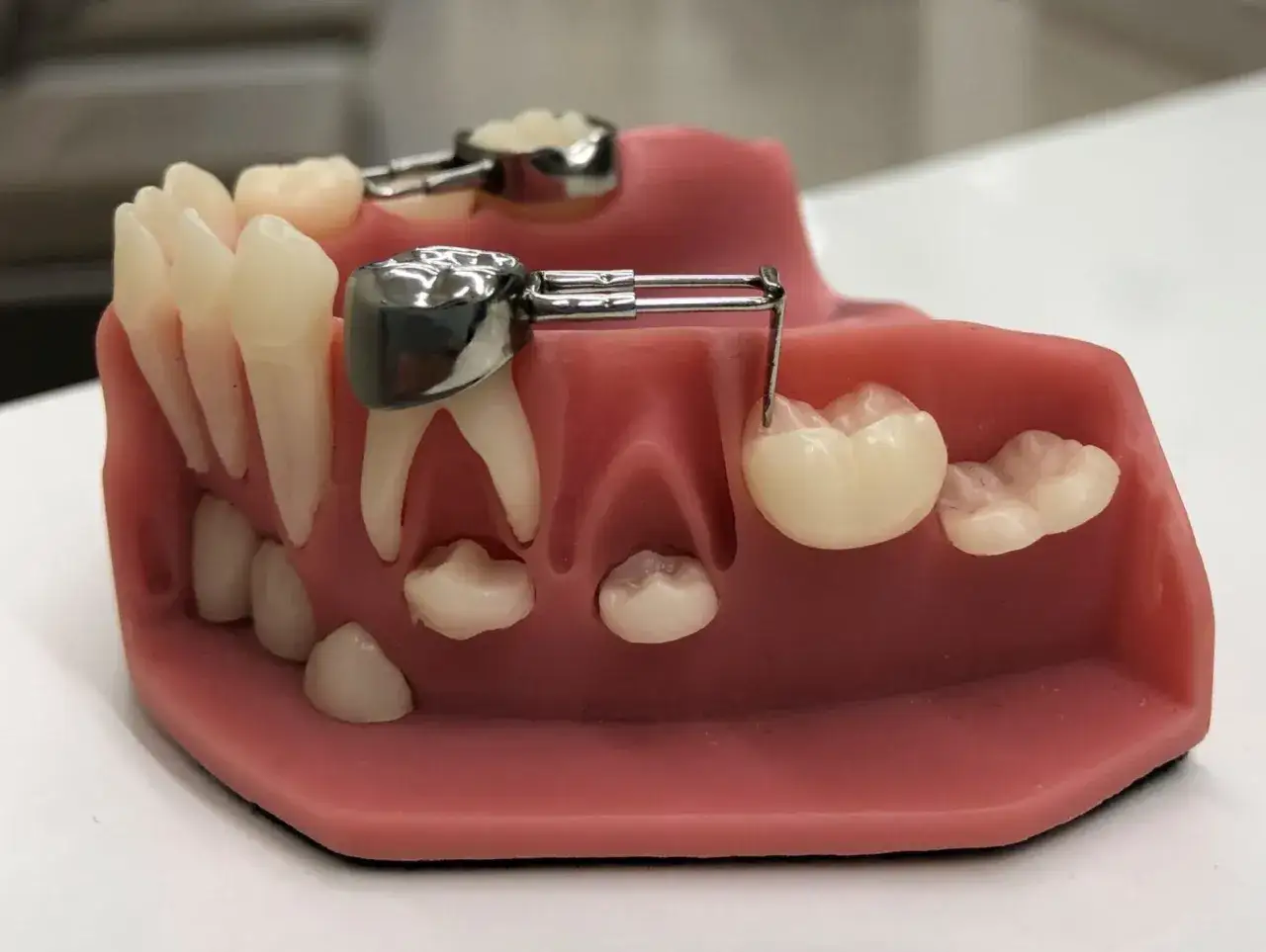 Model szczęki z protezą stałą, zapobiegającą przesuwaniu się zęb&oacute;w po zbyt wczesnym wypadaniu zęb&oacute;w mlecznych.