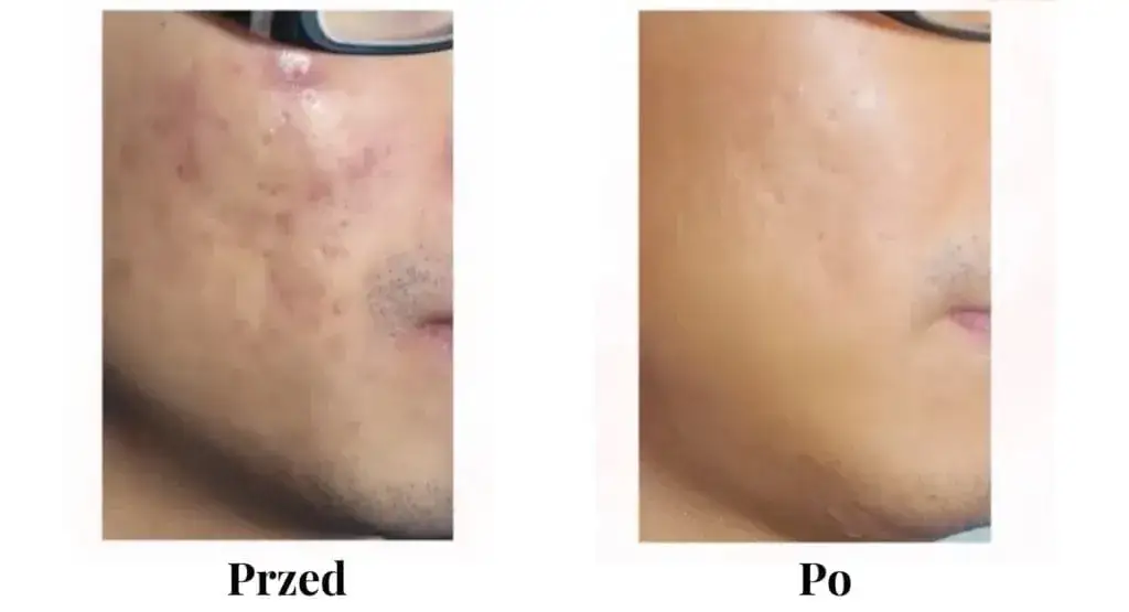 profesjonalne zabiegi na blizny potrądzikowe przed i po