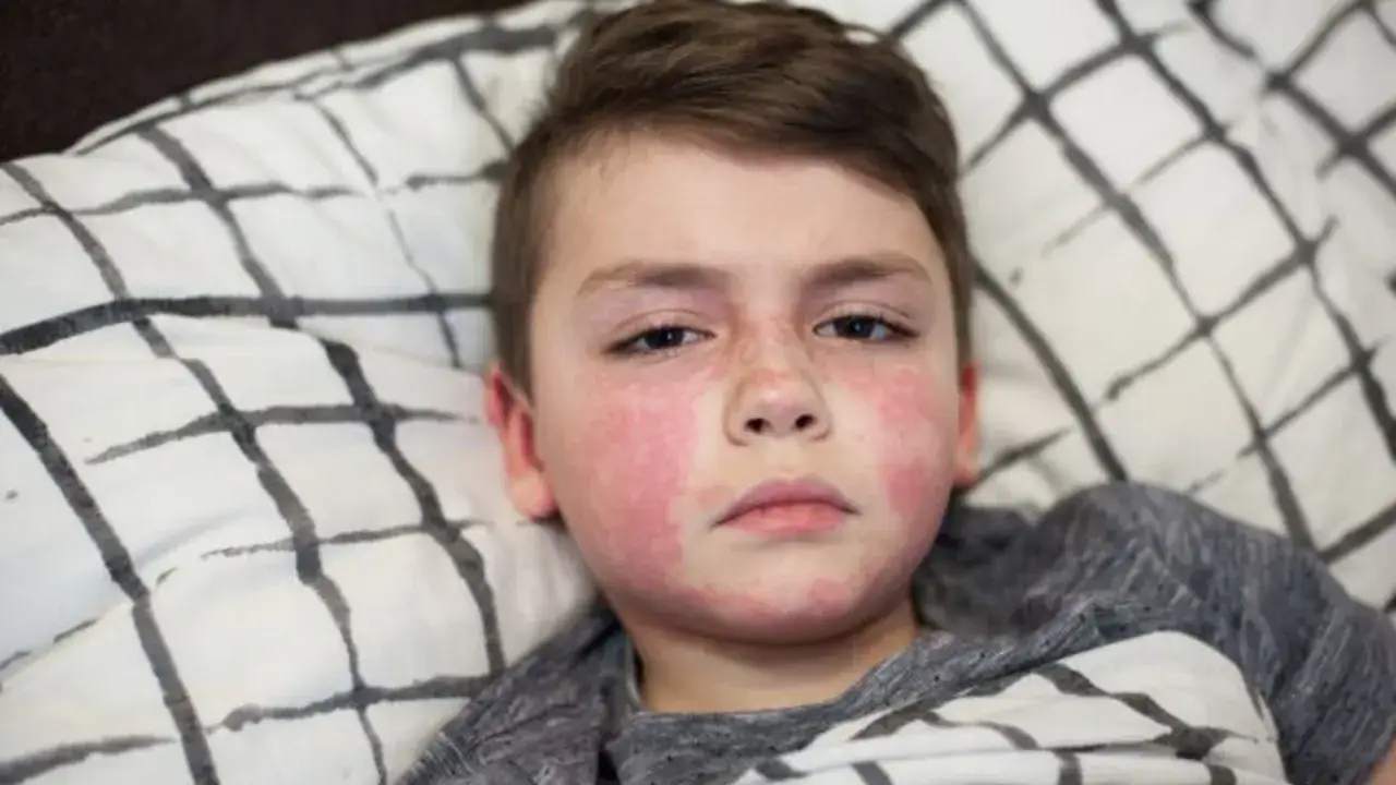 Chłopiec z rumieńcem na policzkach, objawem szkarlatyny u dzieci. Leży w łóżku pod kratkowaną kołdrą.